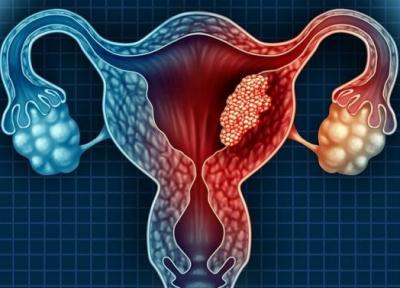 سرطان تخمدان؛ قاتل خاموش زنان