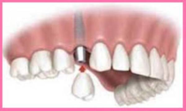 امپلنت های دندانی کوتاه